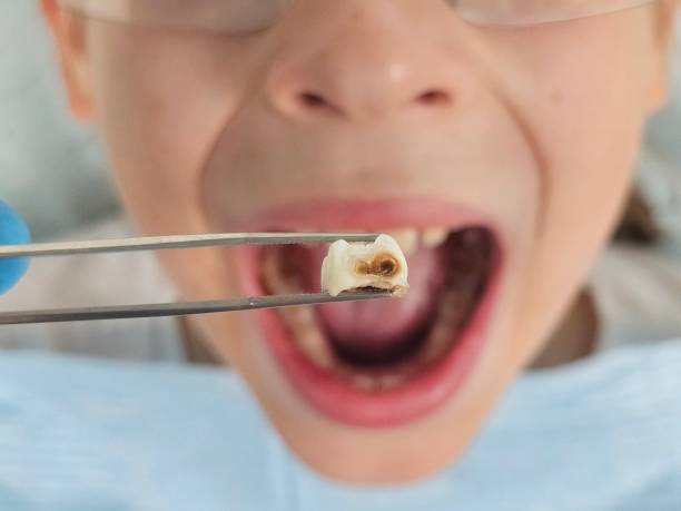 Best Emergency Root Canal Treatment in Springdale, AR